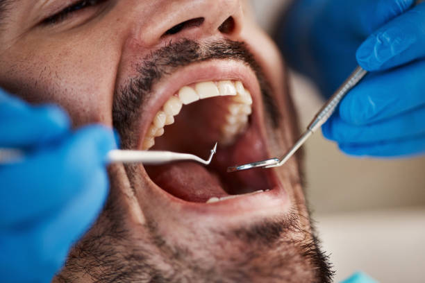 Best Emergency Dentist for Lost Fillings or Crowns in Palos Verdes Estates, CA