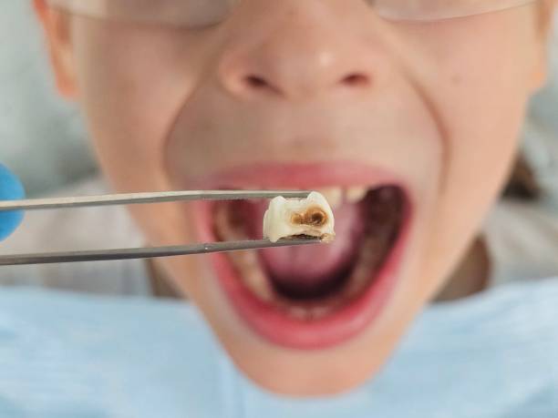 Best Broken or Cracked Tooth Emergency Dentist in Palos Verdes Estates, CA